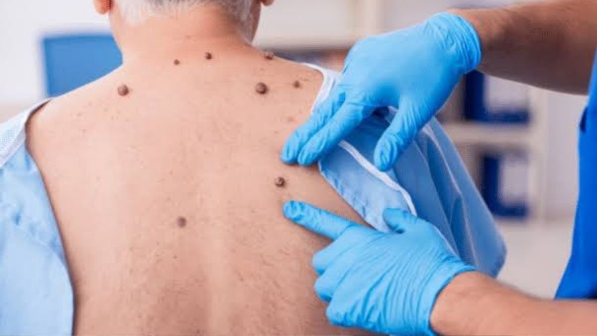 17 Skin Changes That Are Actually Internal Organs Crying for Help. Dermatologists Say #3 Means Insulin Resistance