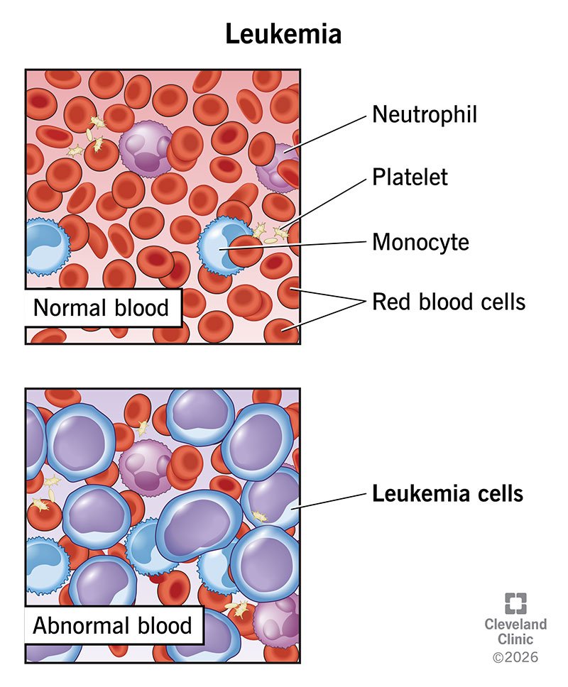 Leukemia Can Sometimes Cause Unusual Retinal Bleeding