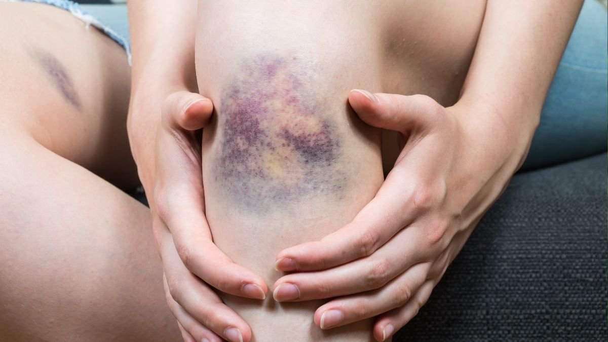 8 Bruising Patterns After 50 That Point to Silent Health Problems, Explained by Hematologists