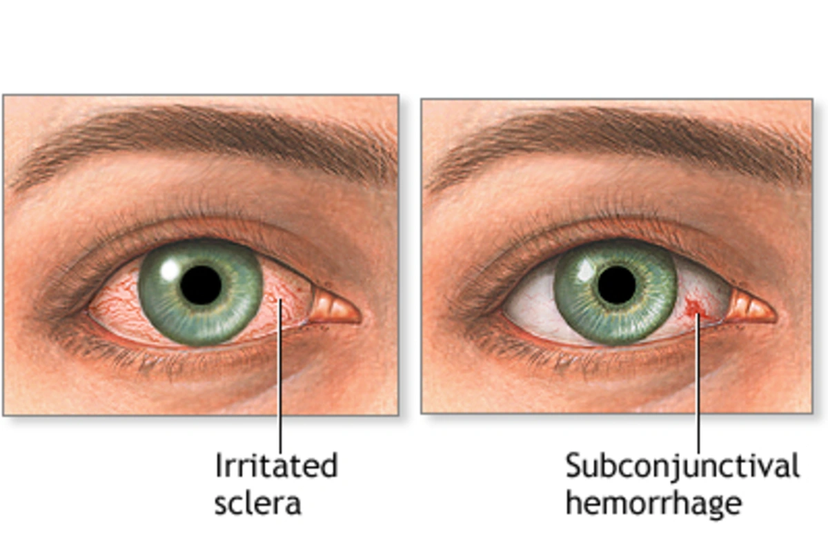 A Bright Red Patch on the White of Your Eye