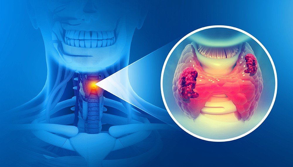 A Family History of a Specific Thyroid Cancer Can Change the Decision Completely
