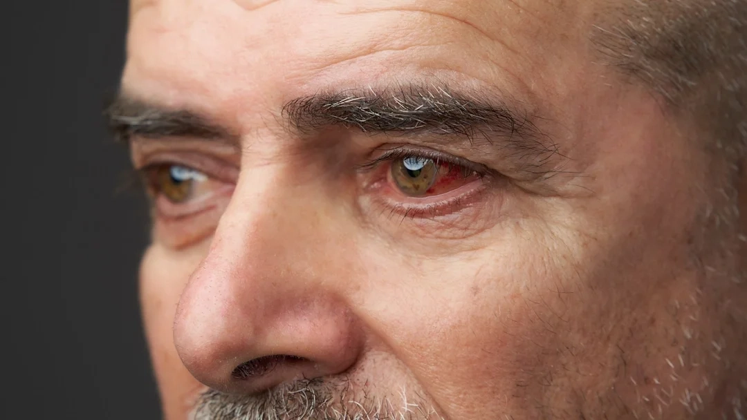 A Painful Red Eye With Nausea Can Be an Emergency