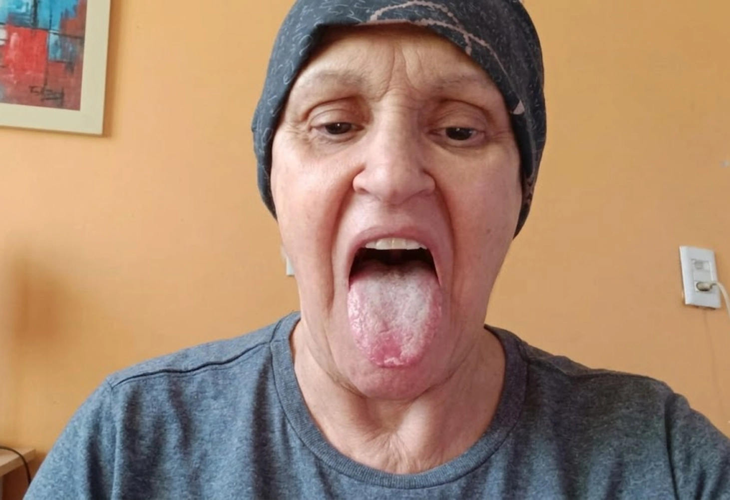 A Sore or Swollen Tongue