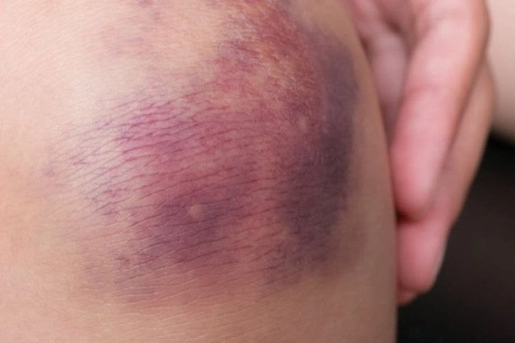 A Sudden Increase in Bruising After Starting a Medication
