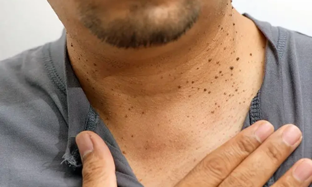 A Sudden Outbreak of Skin Tags