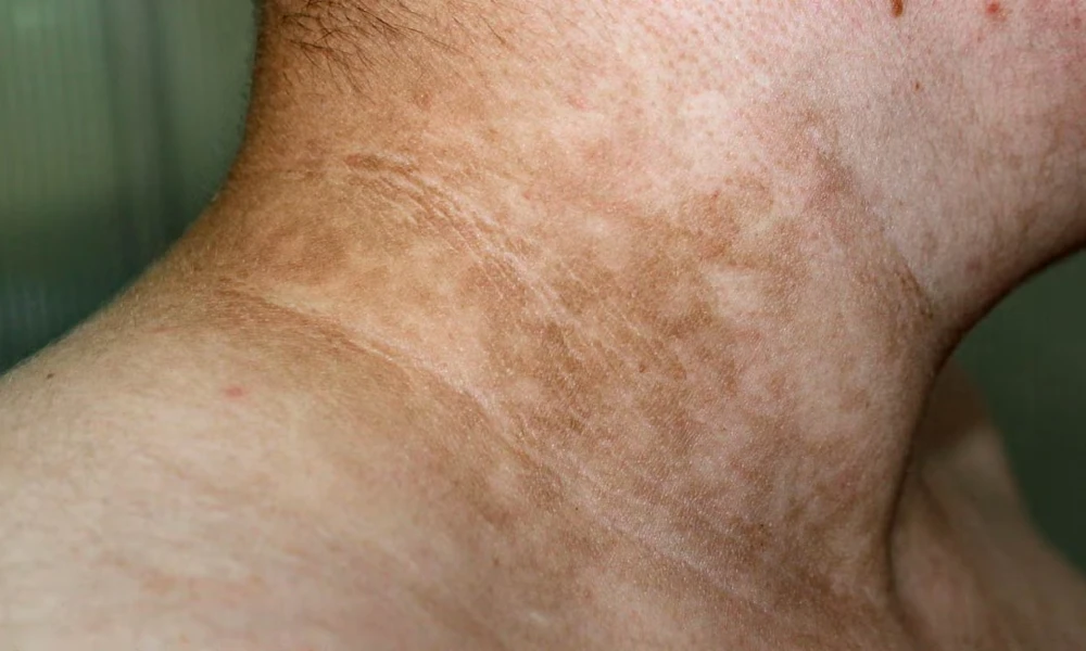 Acanthosis Nigricans (Velvety Dark Patches)