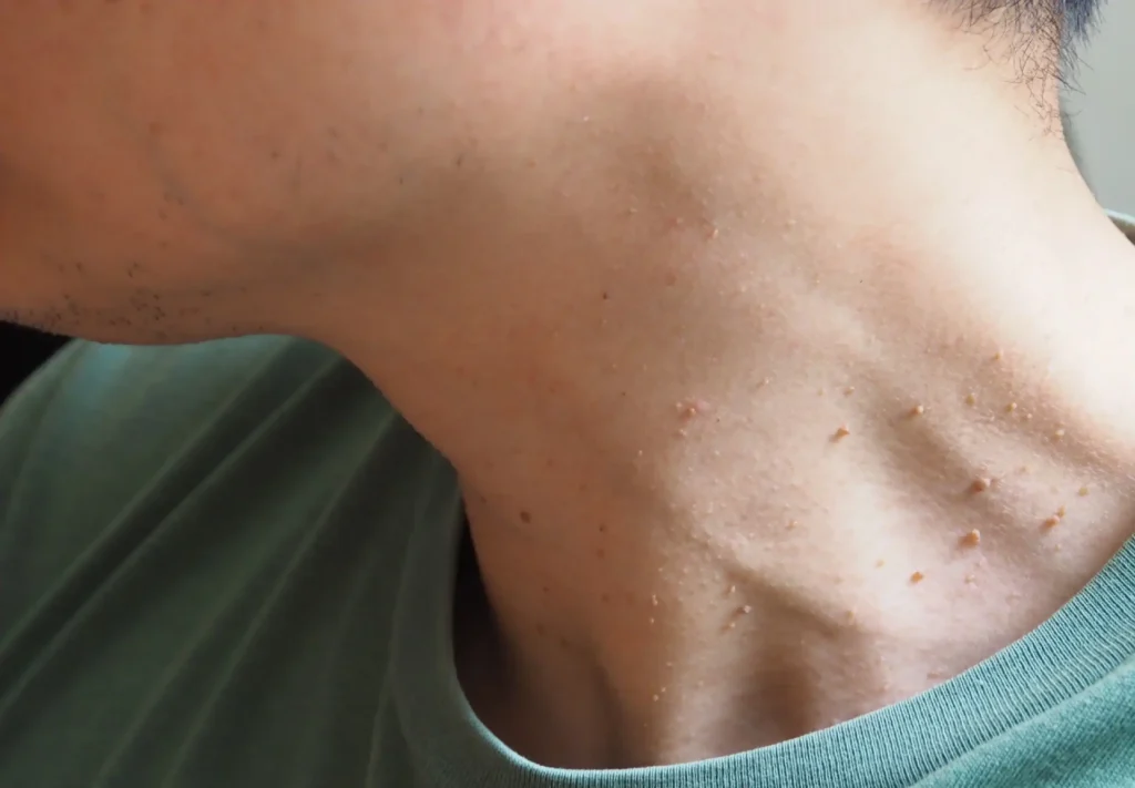 Are Skin Tags More Than Just Skin Tags