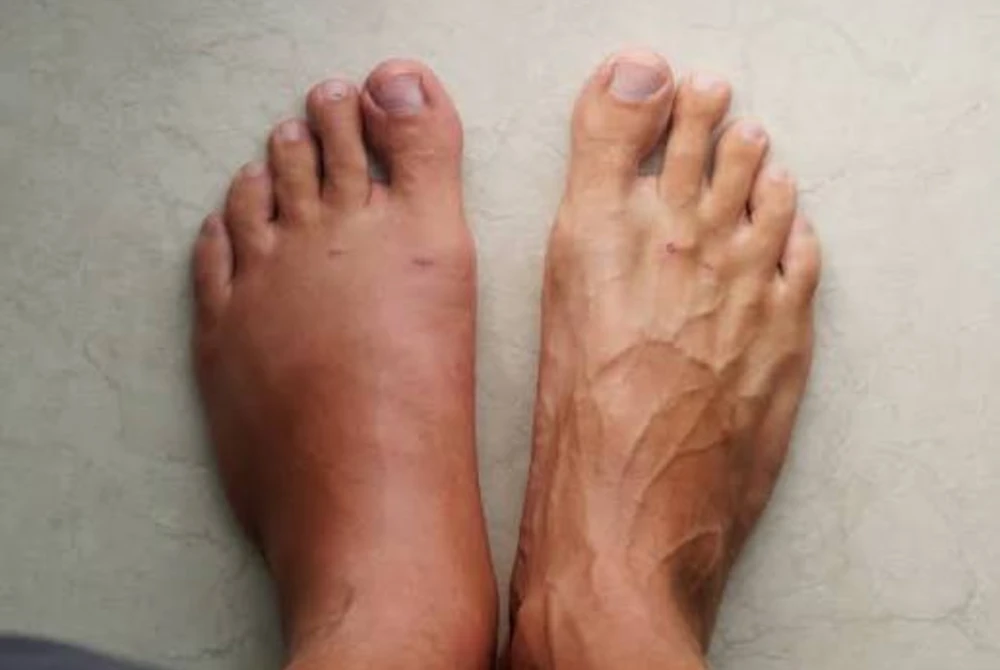 Asymmetrical Swelling in One Foot