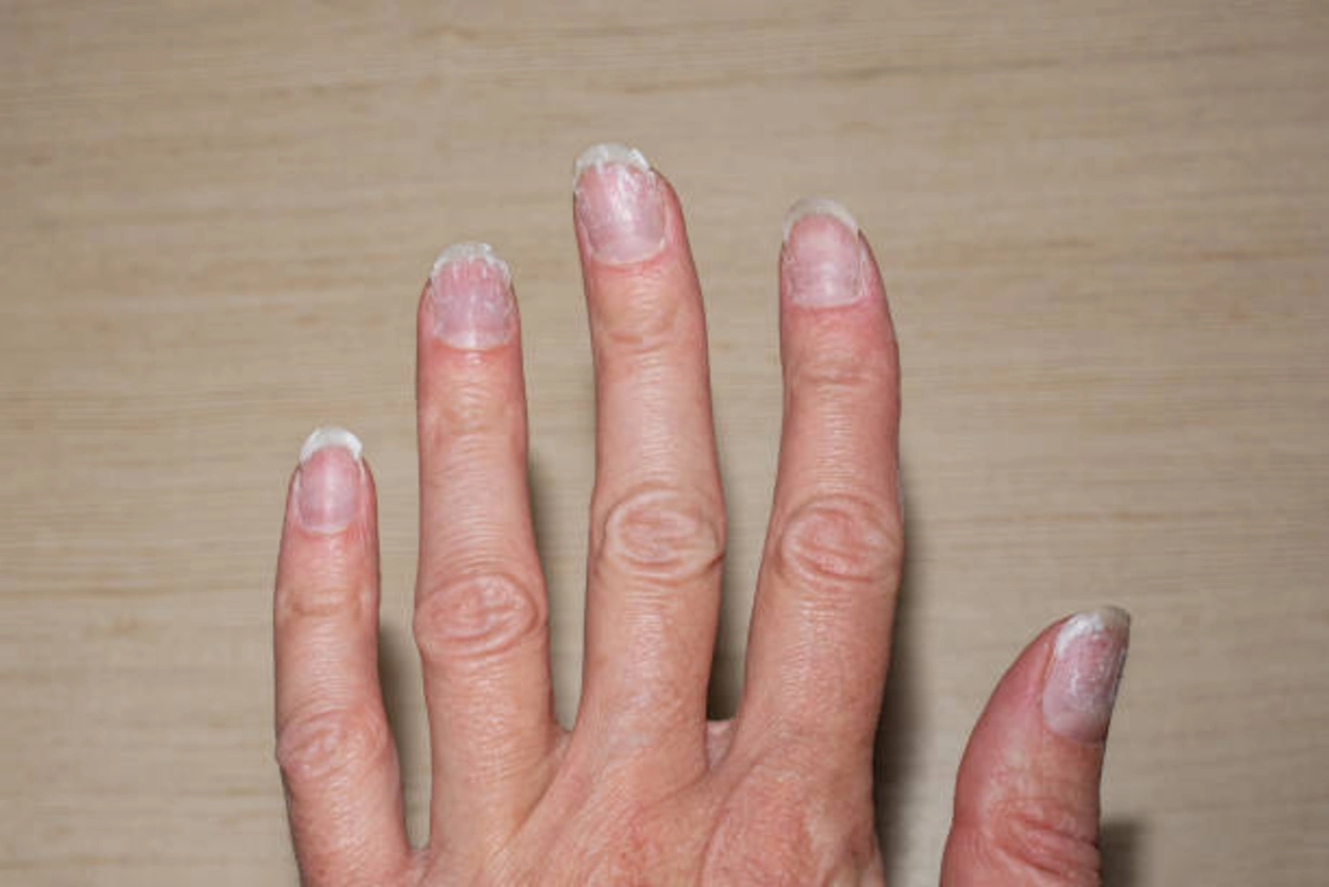 Brittle or Ridged Nails