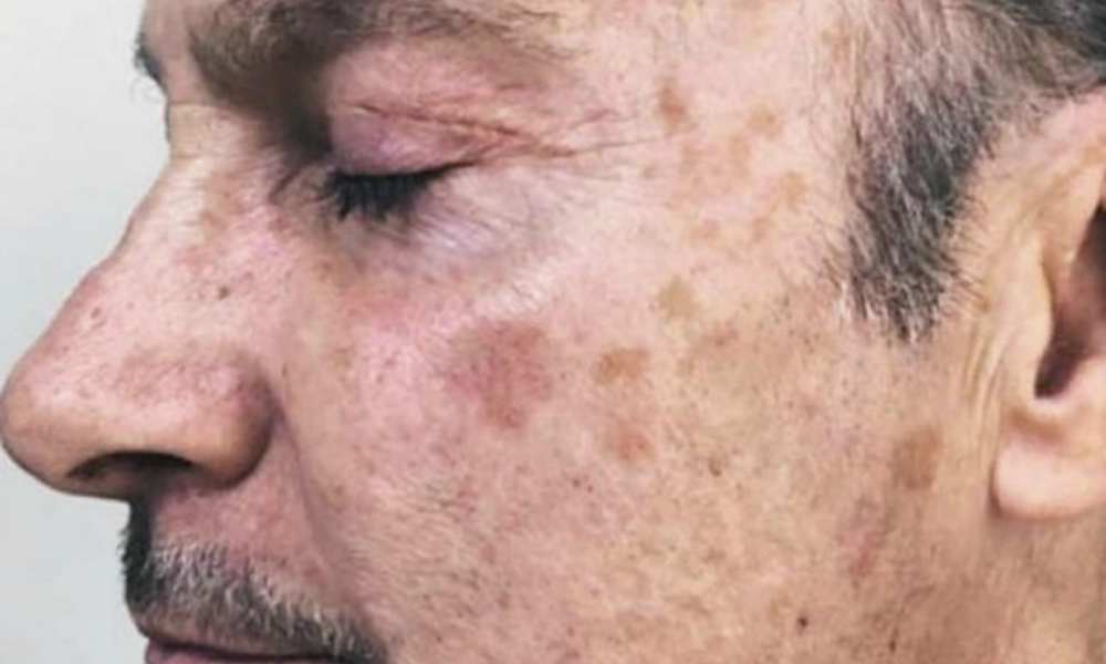 Bronze or Darkening Creases (Addisonian Pigmentation
