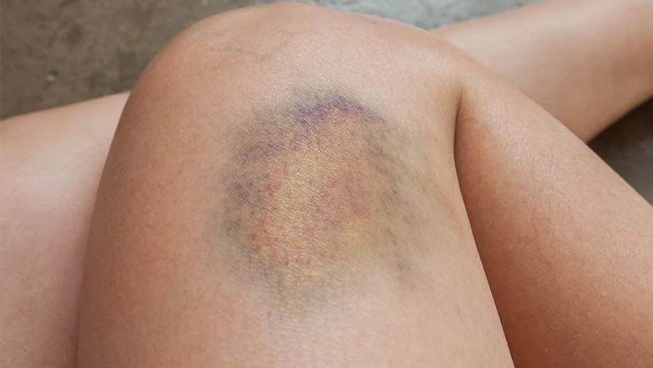 Bruises Appearing Without Any Known Injury