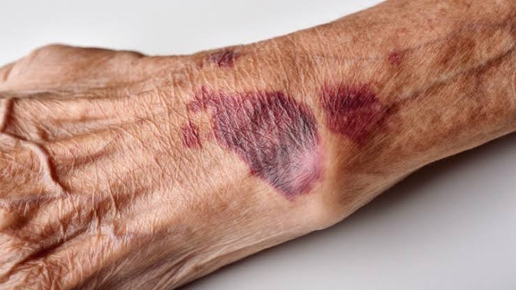 Bruises That Appear Much More Easily