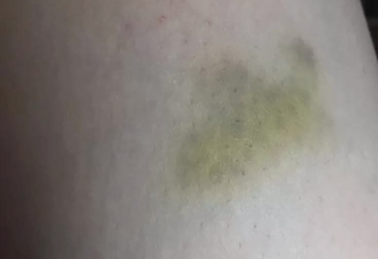 Bruises That Take Much Longer Than Expected to Fade