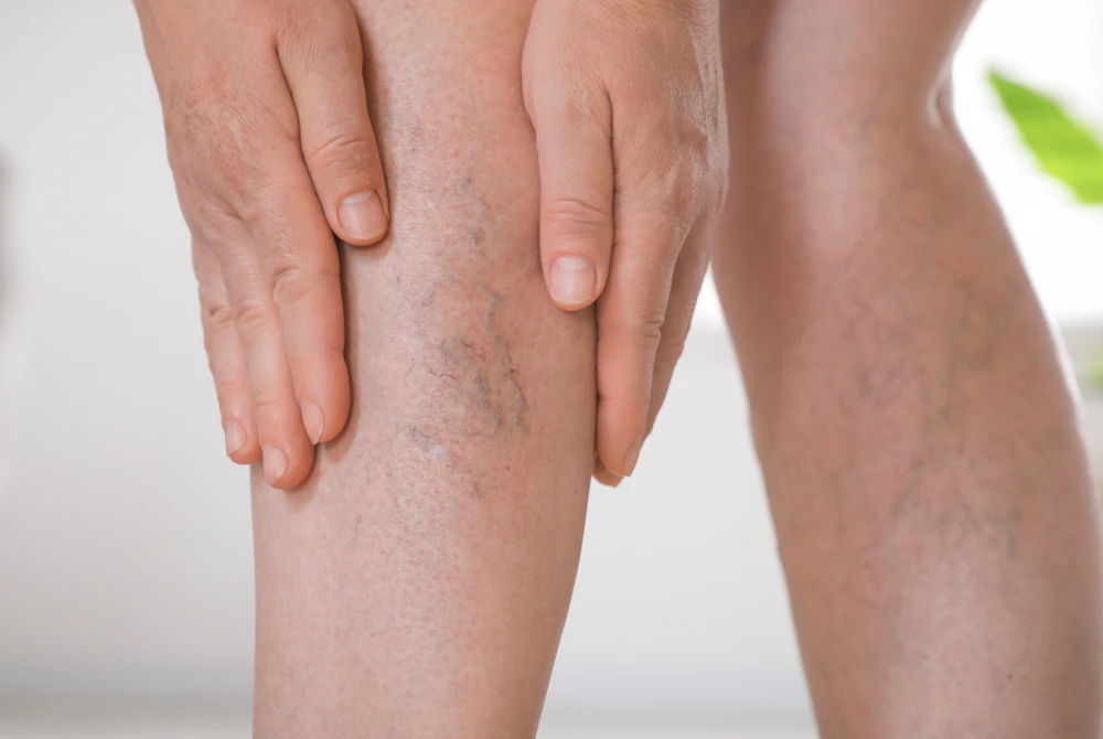 Bulging Varicose Veins