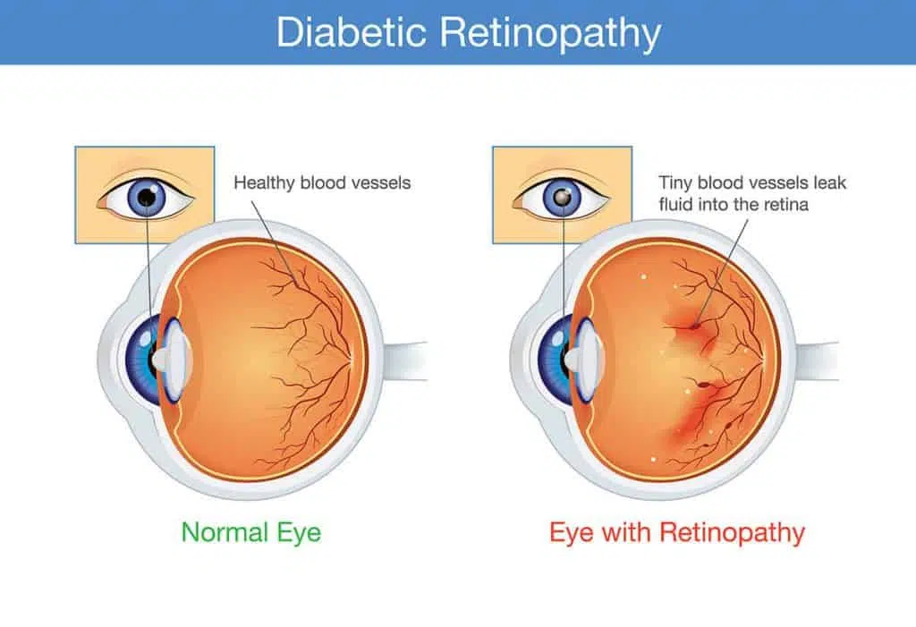 Diabetes Can Damage the Retina