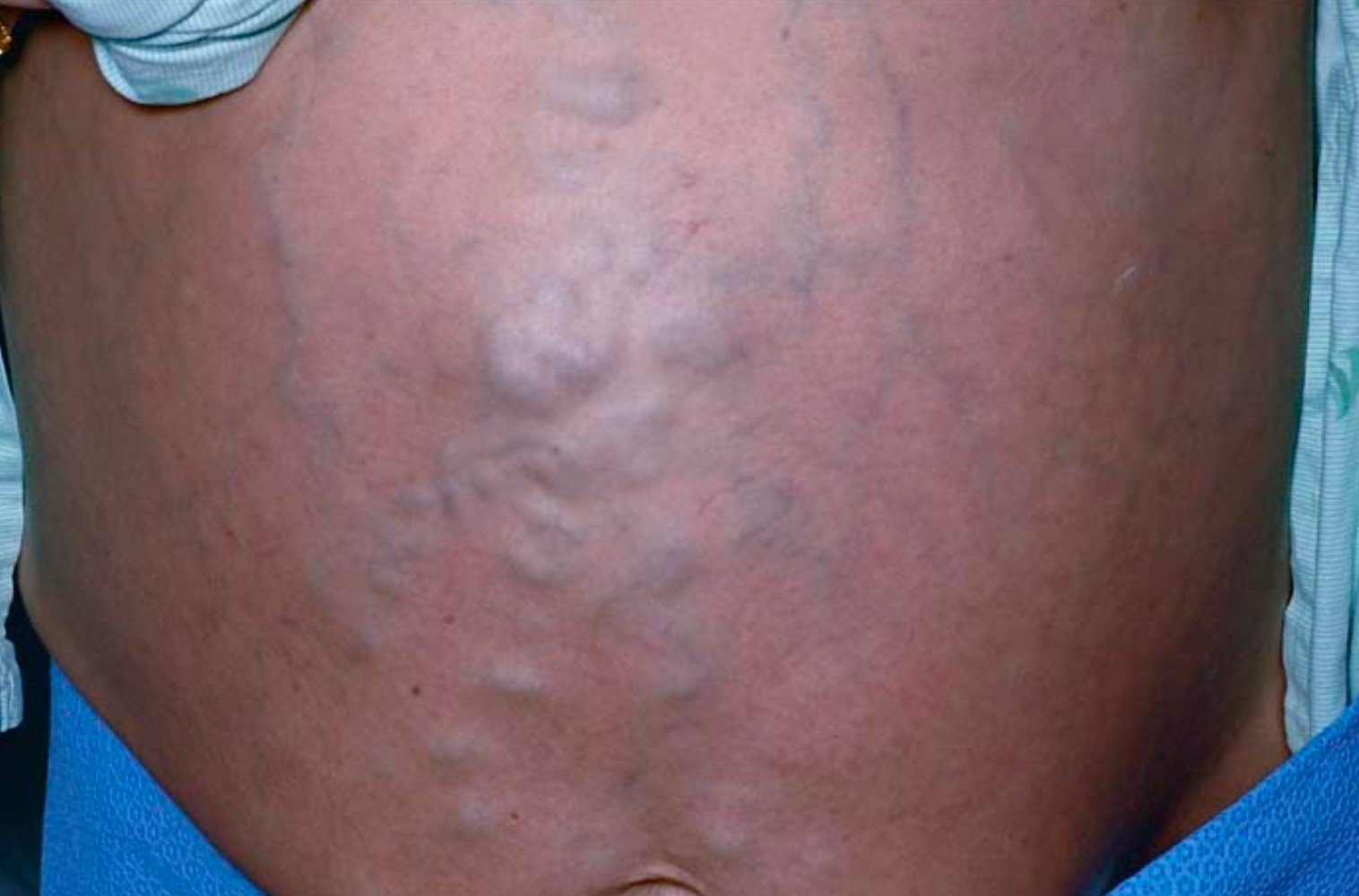 Enlarged Veins Spreading Across the Abdomen