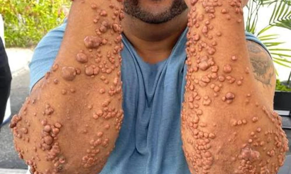 Eruptive Xanthomas (Crop of Red and Yellow Bumps)