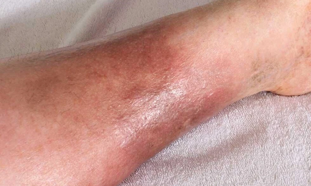 Extremely Dry and Itchy Skin (Uremic Pruritus)
