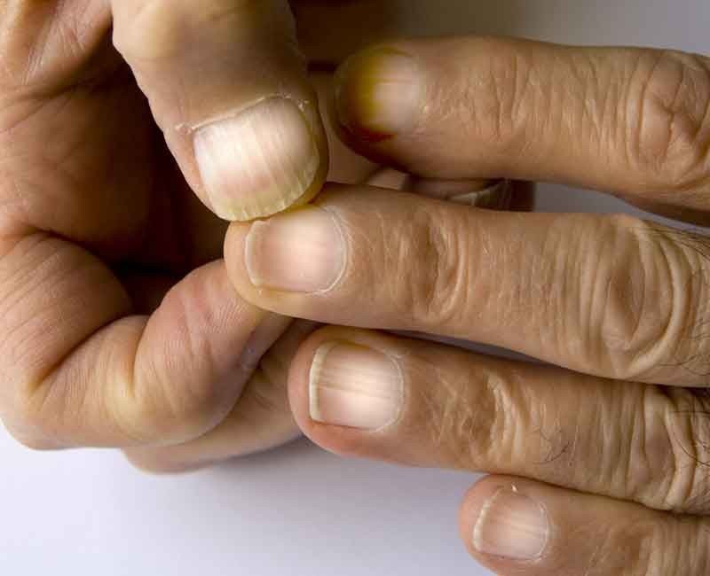 Fingernails That Turn Mostly White