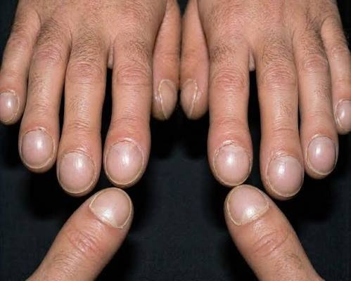 Fingertips Becoming Rounder and More Bulbous