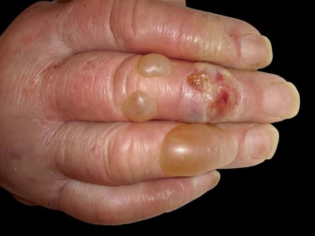 Fragile Skin or Blisters on the Backs of Your Hands