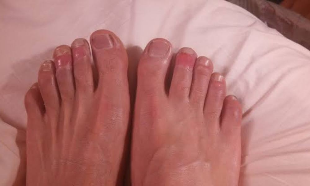 Freezing Toes