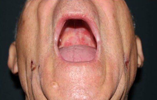 Frequent Mouth Ulcers
