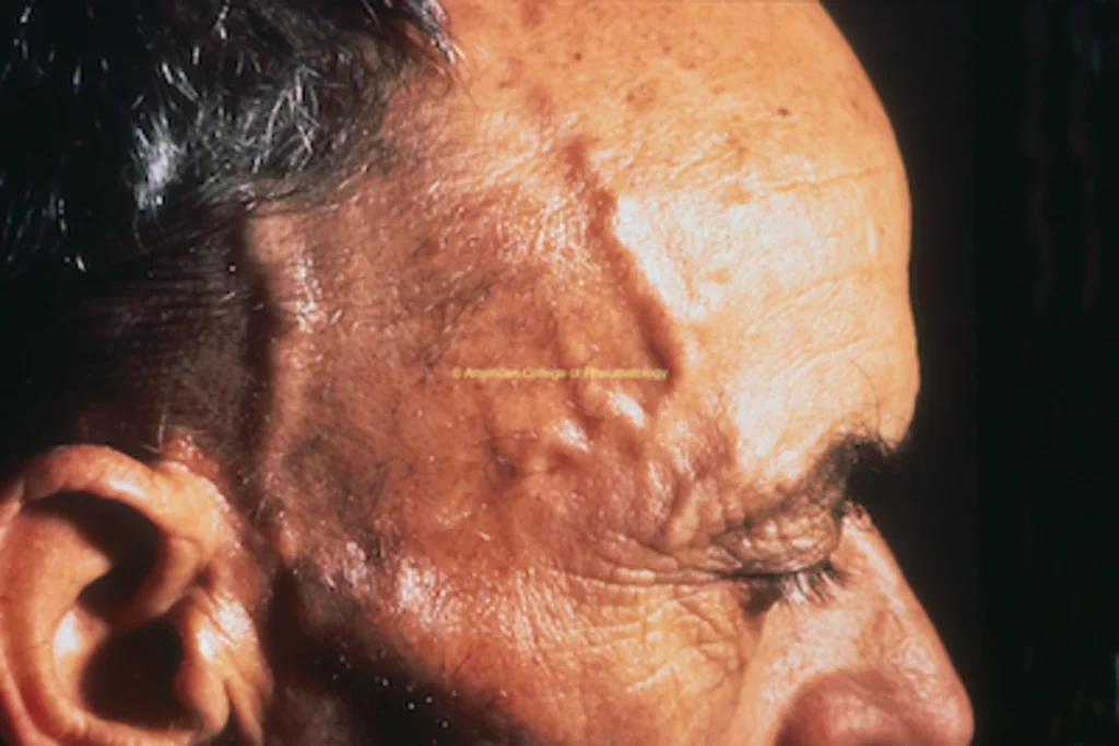 Giant Cell Arteritis Can Threaten Sight Very Quickly
