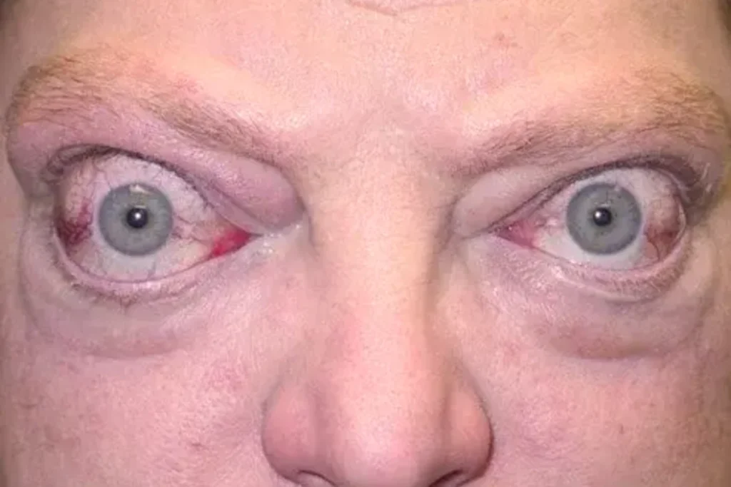 Graves Disease Can Change How Your Eyes Look and Move
