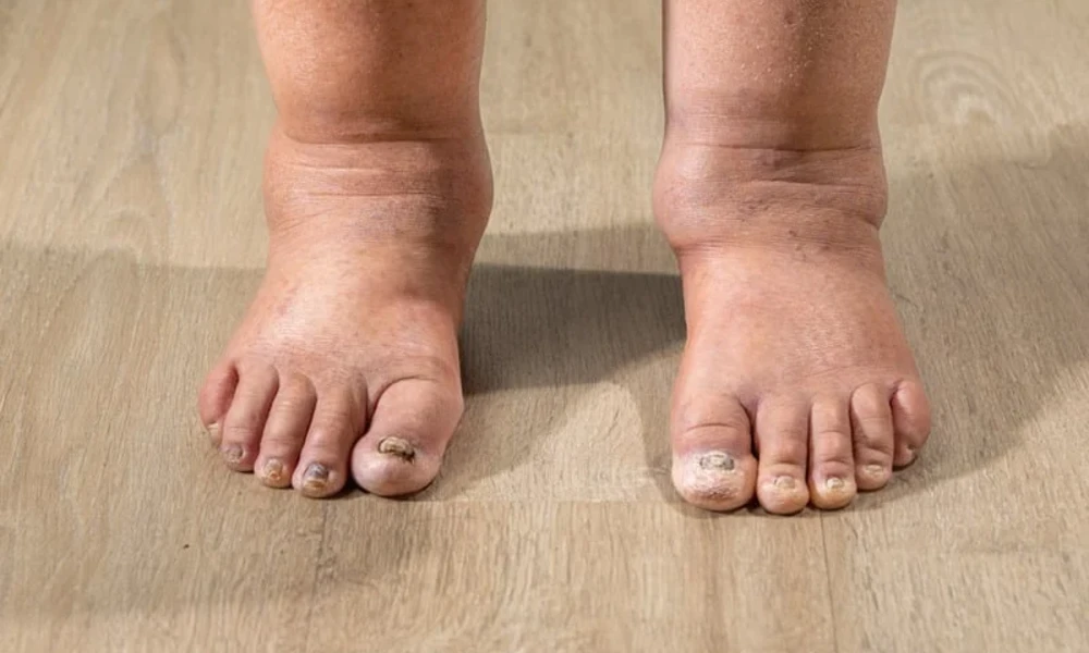 Heavy Water Logged Ankles