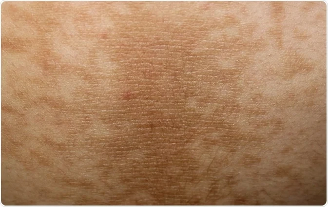 How long does it take for the skin to improve?