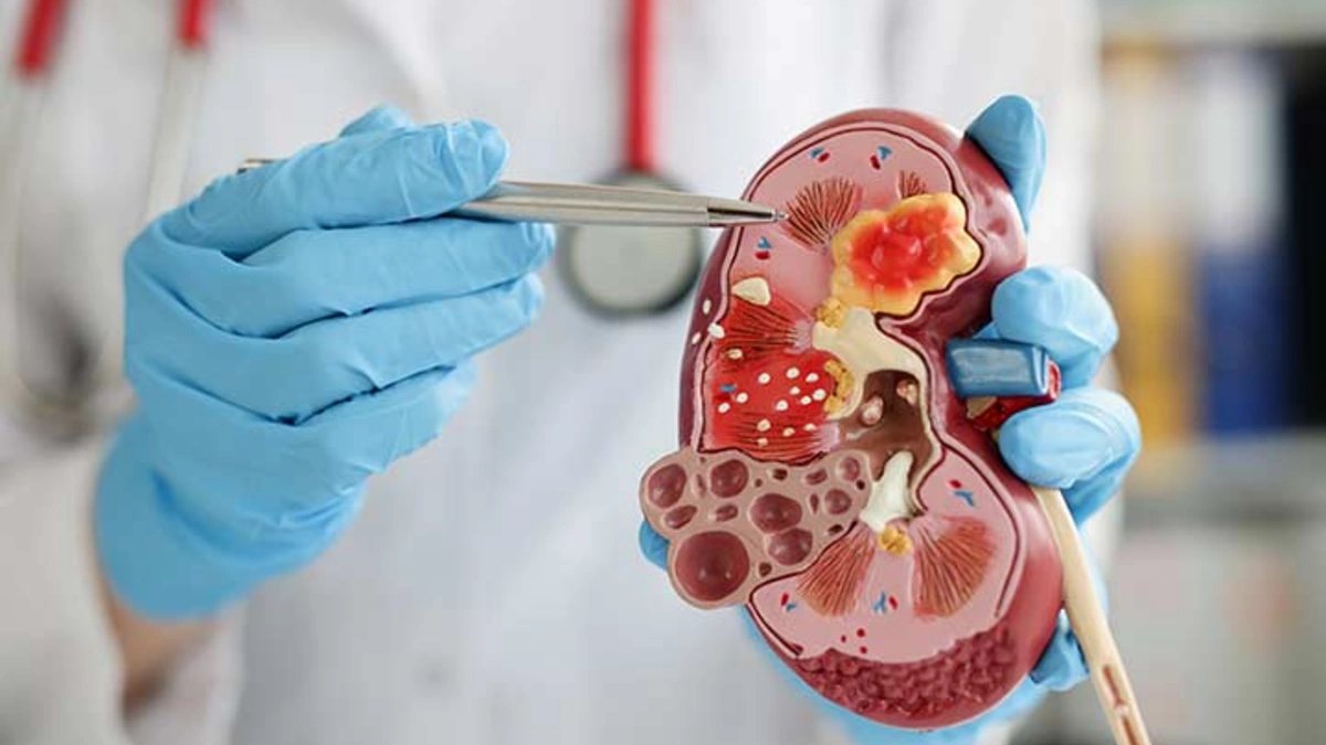 I m a Kidney Doctor and Patients Never Believe Whats Really in Their Healthy Smoothies