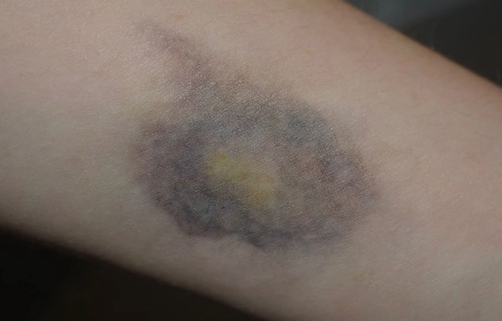 Large Bruises From Very Small Bumps