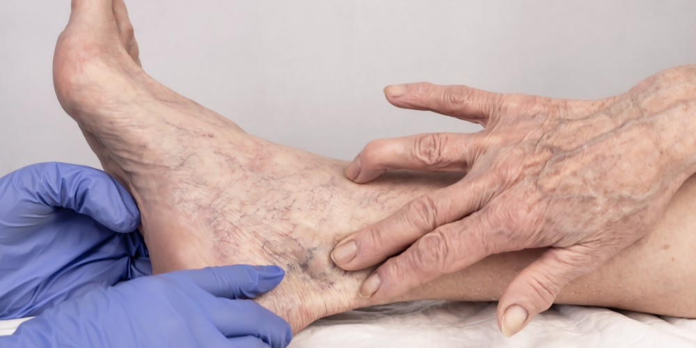 Localized Tenderness Over A Vein