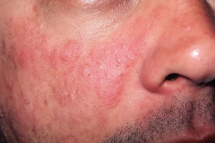Lupus Can Affect Both the Front and Back of the Eye