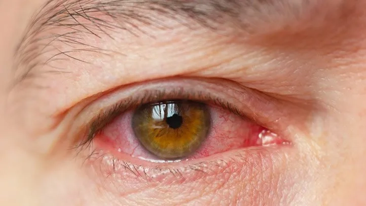 Lymphoma Can Sometimes Mimic Eye Inflammation