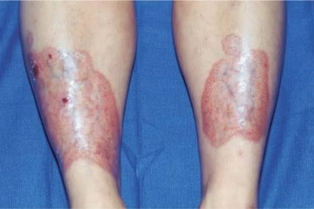 Necrobiosis Lipoidica