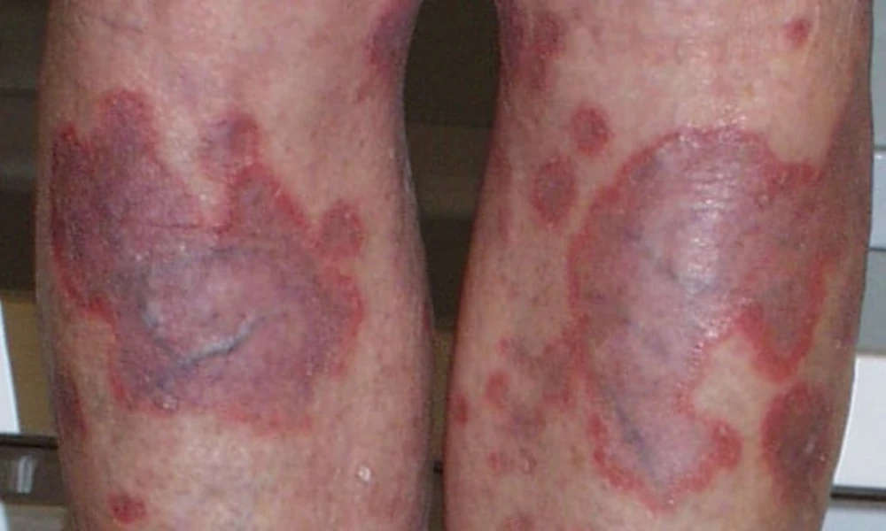 Necrobiosis Lipoidica (Yellowish Waxy Plaques on Shins)