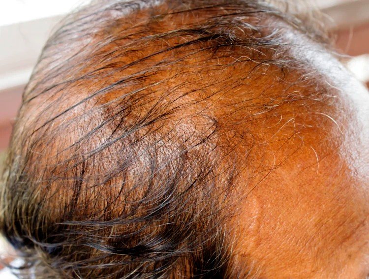 Noticeable Loss of Body Hair