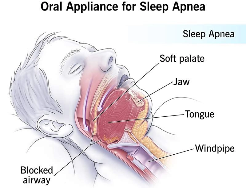 Oral appliances