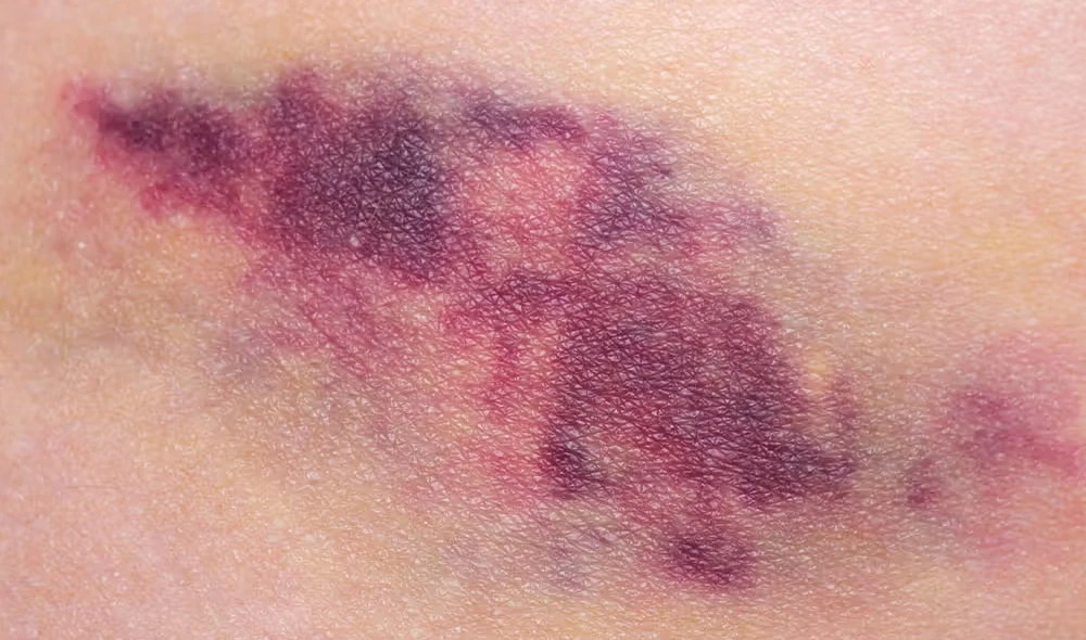 Painful, Raised, or Hard Bruises