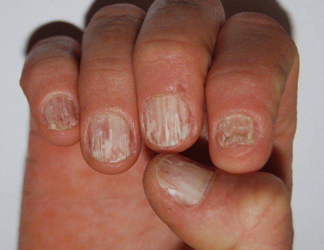 Paired White Lines Across Several Nails