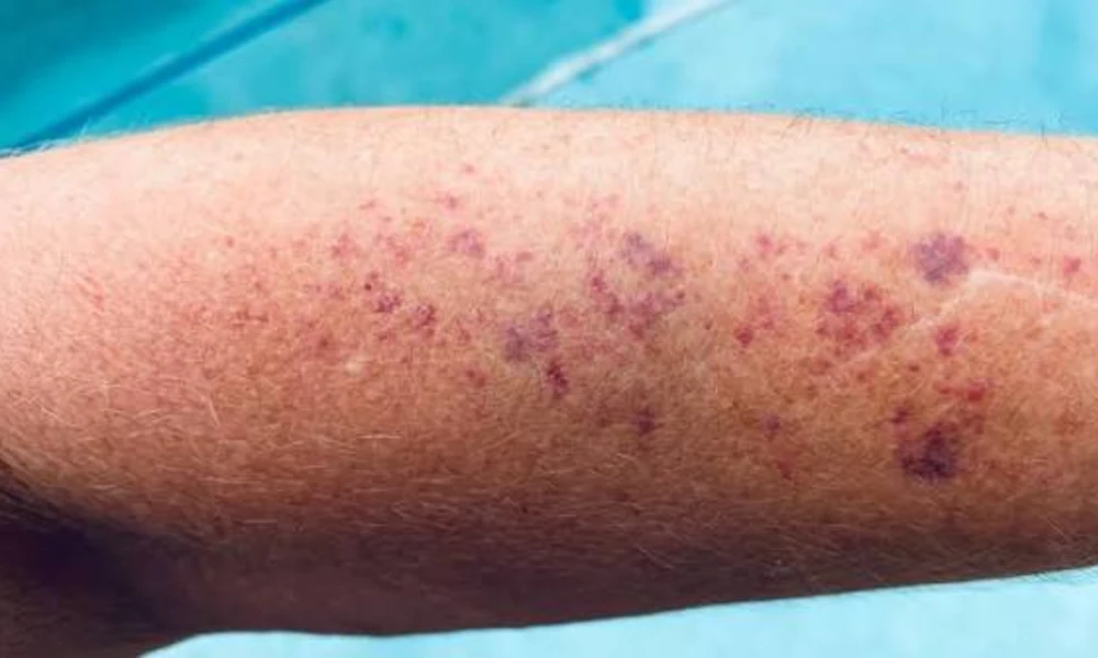 Petechiae (Tiny Red or Purple Dots)