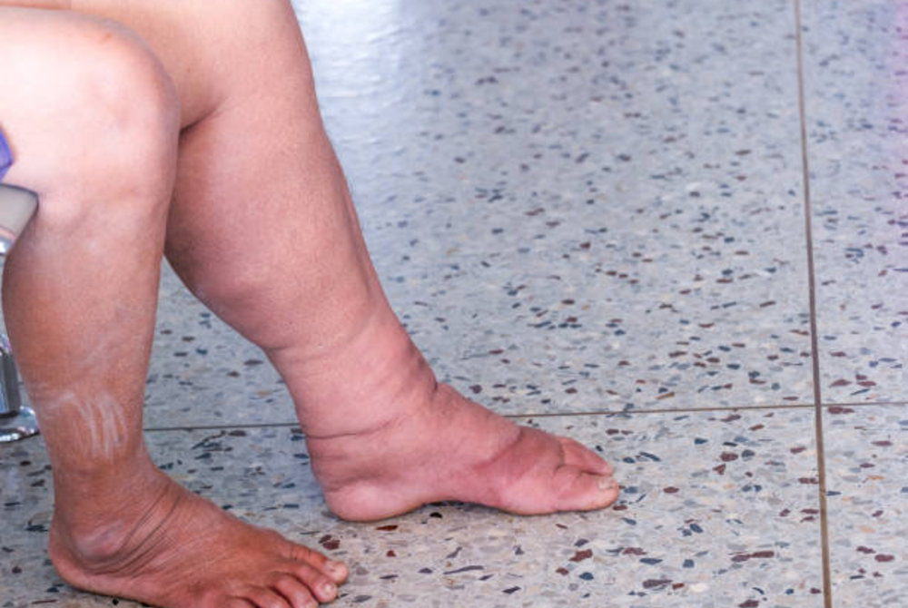 Pitting Edema and Swelling