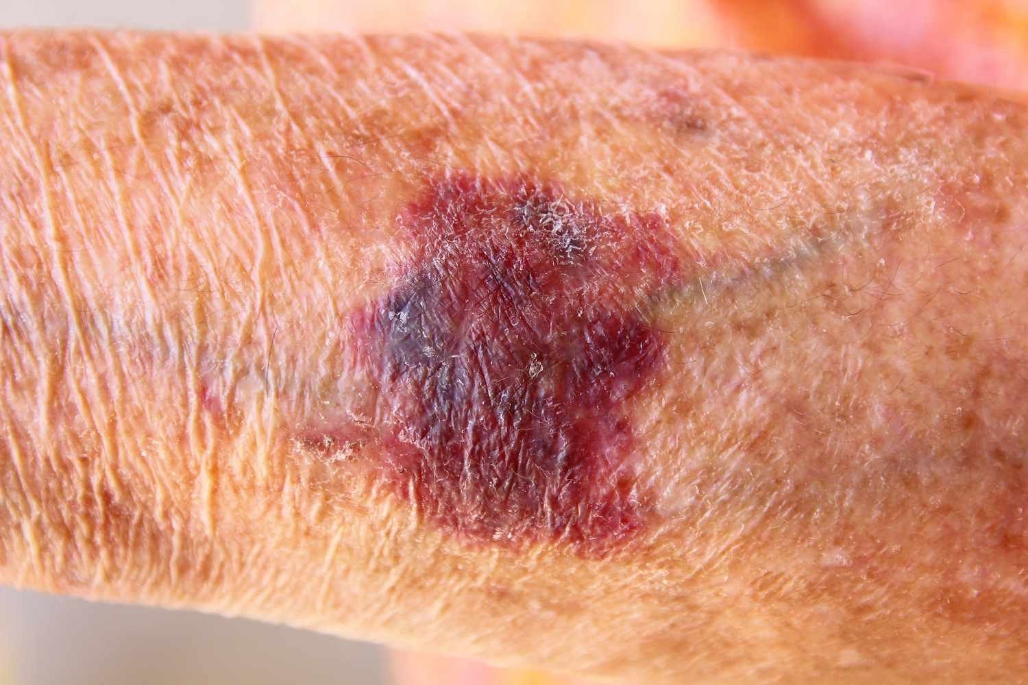 Purple, Flat, Intensely Itchy Patches