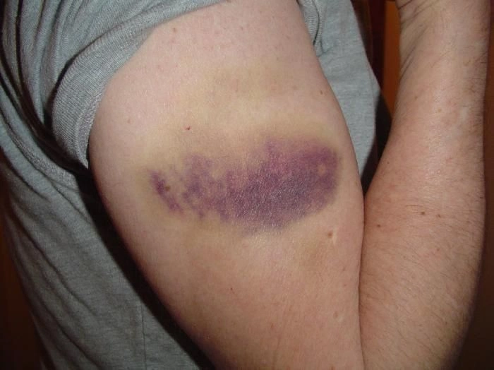 Purple Patches on Hands and Forearms