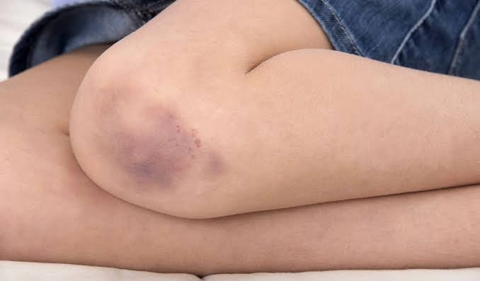 Common Questions About Unusual Bruising