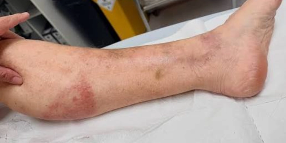 Redness Spreading Across The Calf