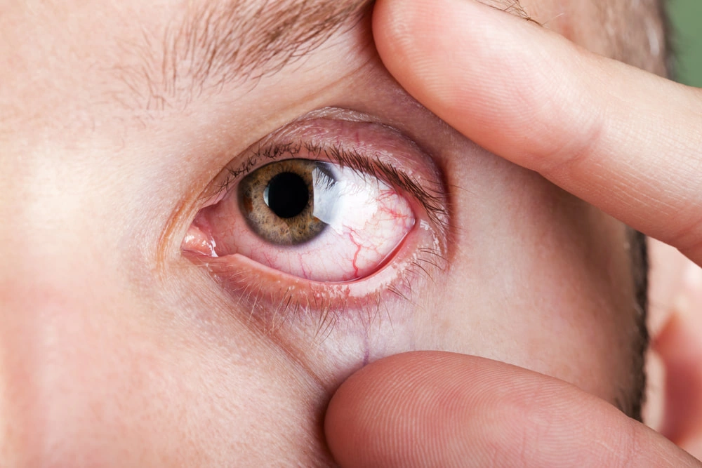 Sarcoidosis Can Cause Inflammation Inside the Eye