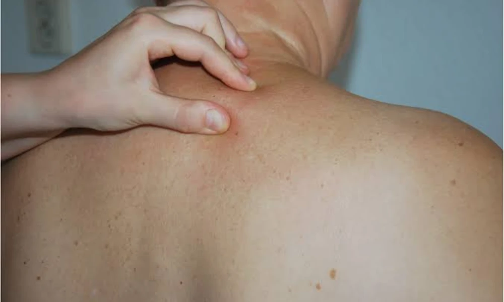 Scleredema (Thick and Tight Skin on the Upper Back)